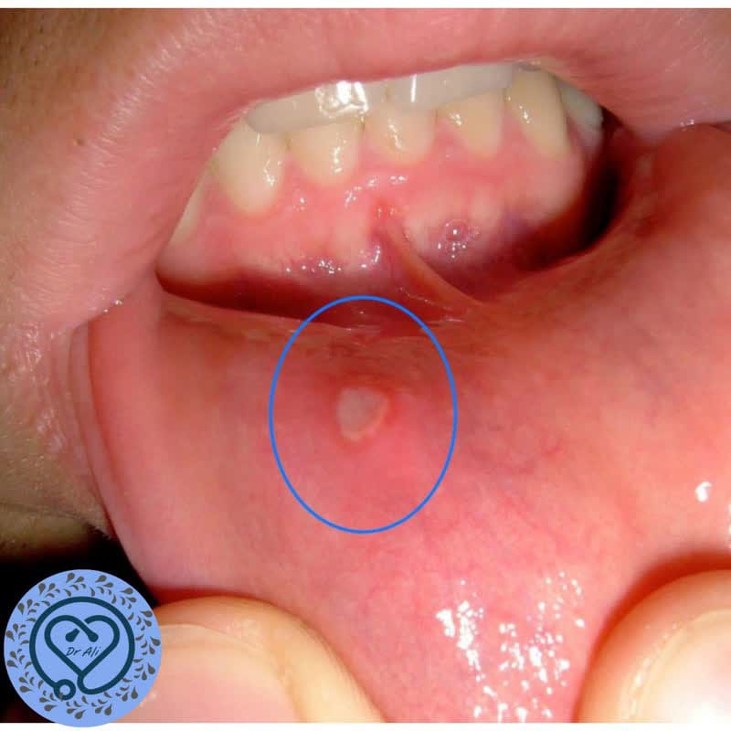 نسخه های درمانی برای آفت دهان نسخه نویسی آفت